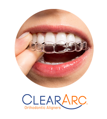 Invisible Aligners for Teeth