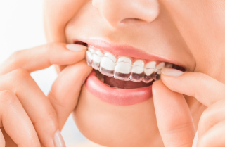 Alternatives to Traditional Braces
